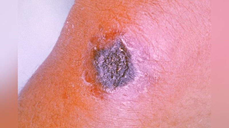 'Жиззахда икки киши “куйдирги” касаллигида гумонланиб, шифохонада даволанаётгани юзасидан изоҳ берилди'ning rasmi