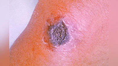 'Жиззахда икки киши “куйдирги” касаллигида гумонланиб, шифохонада даволанаётгани юзасидан изоҳ берилди'ning rasmi