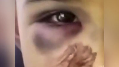 Изрображение 'В Ургуте маленький ребенок пришел в детсад избитым'