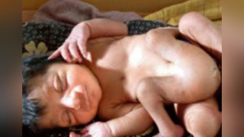 'Ҳиндистонда тўрт оёқли чақалоқ туғилди'ning rasmi