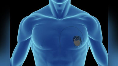 Изрображение '​РАЗРЕШЕНЫ ЛИ ФИЗНАГРУЗКИ ЛЮДЯМ С КАРДИОСТИМУЛЯТОРОМ?'