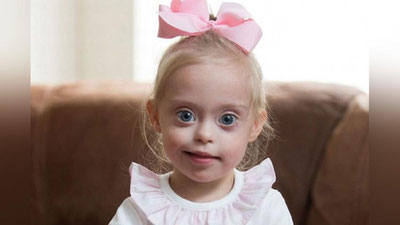 ' BOLALARDAGI DAUN XASTALIGINING  BELGILARI'ning rasmi