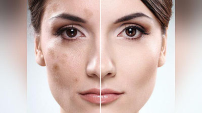 '​Юздаги доғлардан халос бўлишнинг замонавий 6 усули'ning rasmi