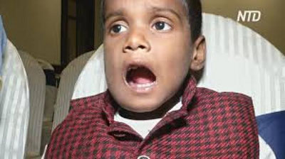 'Hindistonlik bolakayning 526 ta ortiqcha  tishi olindi'ning rasmi