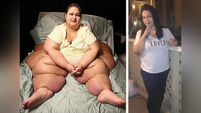 '​453 kilogrammlik vazndan qutulib, qaddi-qomati go`zallashgan ayol'ning rasmi