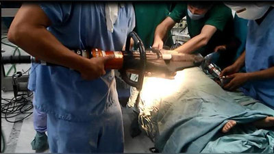 Изрображение 'ТАШКЕНТСКИЕ СПАСАТЕЛИ ВЫЗВОЛИЛИ РУКУ 3-ЛЕТНЕГО РЕБЕНКА ИЗ МЯСОРУБКИ'