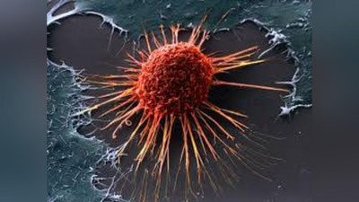 'Oxirgi bosqichdagi saratonga ham dori topildi'ning rasmi