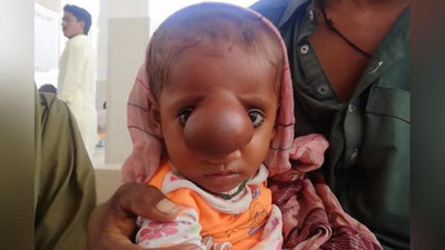 'Bolakay yuzida miyasi bilan tug`ildi 'ning rasmi