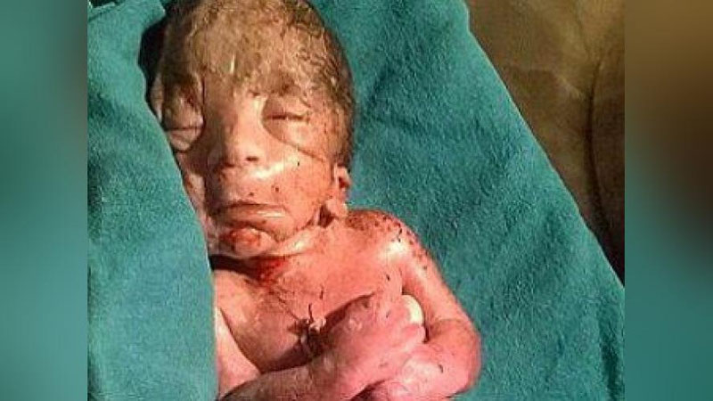 Изрображение 'В Индии родился ребёнок с синдромом русалочки (Фото)'