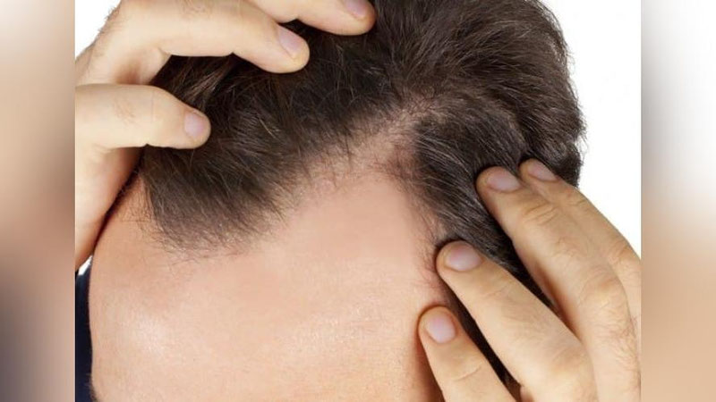 'Soch ektirish qanchaga tushadi? Ekilgan  sochlar to`kiladimi?  Soch ektirish kimlarga mumkinmas?'ning rasmi