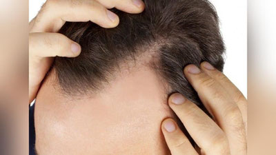 'Soch ektirish qanchaga tushadi? Ekilgan  sochlar to`kiladimi?  Soch ektirish kimlarga mumkinmas?'ning rasmi