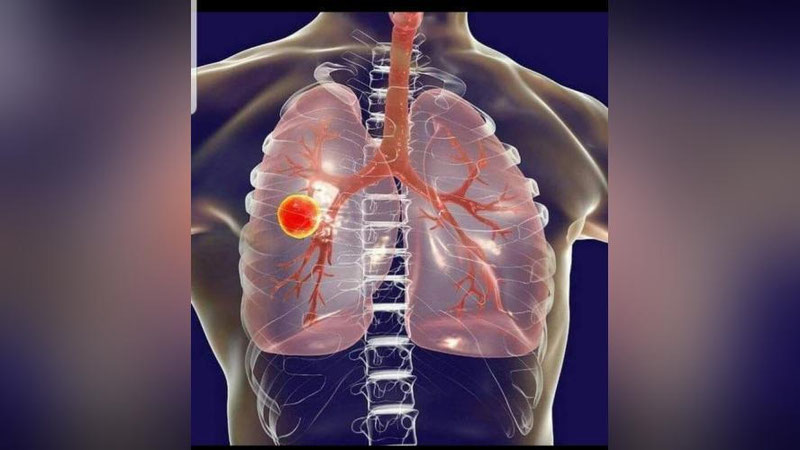 'Koronavirus o`tkazgandan so`ng o`pkada shikastlanish qolmasligi uchun nima qilish kerak?'ning rasmi
