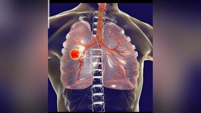 'Koronavirus o`tkazgandan so`ng o`pkada shikastlanish qolmasligi uchun nima qilish kerak?'ning rasmi