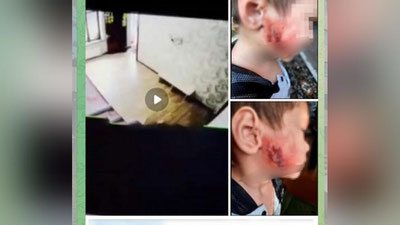 'Toshkentdagi bog`chada bolaning yuzi kuyib jarohatlanganiga tibbiy vosita bilan bo`yoqlarni o`chirilgani sabab qilib ko`rsatilmoqda. IIBB tergovga qadar tekshiruv boshladi'ning rasmi