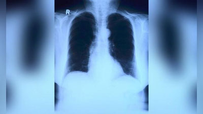 Изрображение 'В России воспитательница детсада заразила туберкулезом 9 детей'