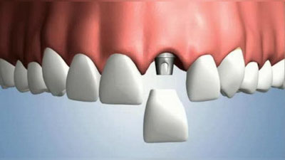 'Шифо маслаҳат: “ИМПЛАНТНИ ЯНГИЛАСА БЎЛАДИМИ?”'ning rasmi