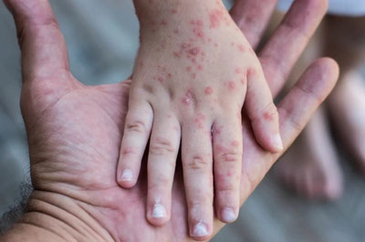 Image of 'A new virus is spreading in kindergartens and schools in Russia.'