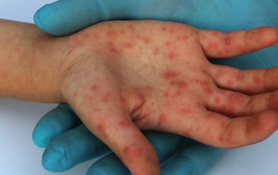 Image of 'Cases of measles infections in the world increased by 20 percent — WHO'