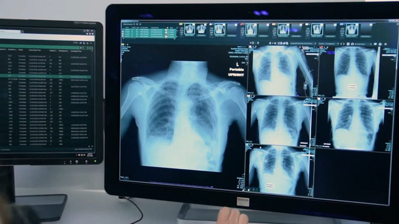 Image of 'WHO has approved a new diagnostic method designed for the rapid detection of tuberculosis.'