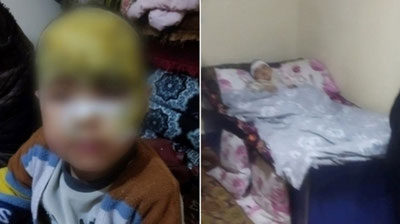 Image of 'In Kashkadarya, a caretaker accidentally spilled boiling water on a child's forehead.'