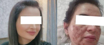 Изрображение 'В Ташкенте девушка получила химический ожог лица в салоне красоты'