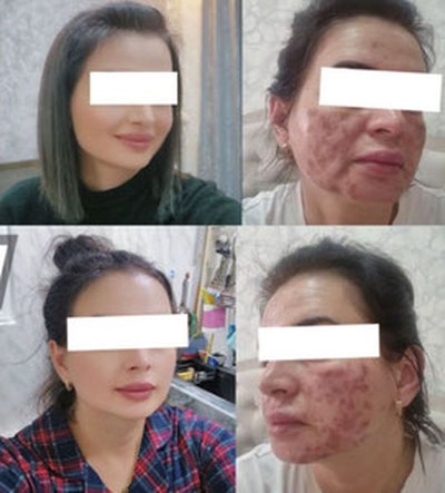 'Тошкентдаги салонда аёлнинг юзи куйдириб қўйилди'ning rasmi