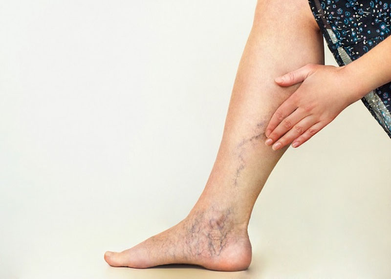 Image of 'Who is affected by varicose veins, and in what situations do they occur?'