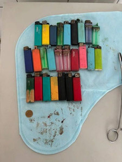 Image of 'The Russian patient had 27 lighters removed from their esophagus.'