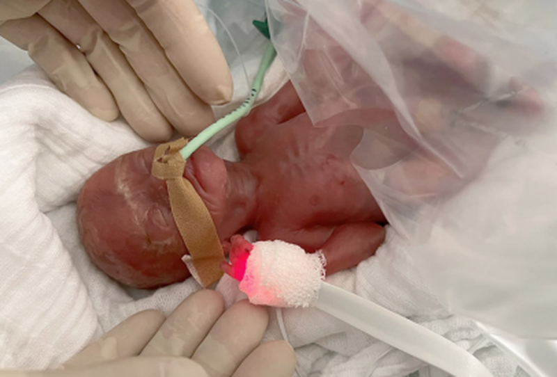 Изрображение 'В Германии врачи спасли младенца, весившего всего 300 граммов'