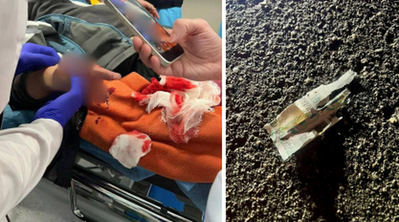 Изрображение 'В Подмосковье ребенку оторвало пальцы: он поднял с земли сверток денег, который взорвался'