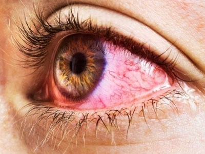 'Россияда шифокорлар аёлнинг кўзидан тирик қурт чиқарди'ning rasmi