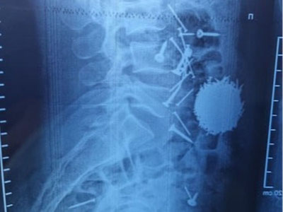 Изрображение 'В Самарканде из желудка 29-летнего мужчины извлекли 200 граммов гвоздей'