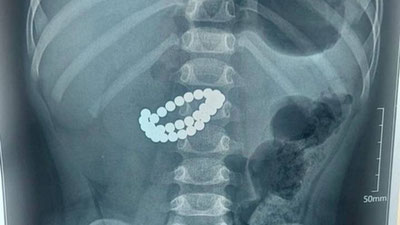 'Qozog‘istonda 1 yoshli bolaning ichag‘idan 31 ta magnit olib tashlandi.'ning rasmi