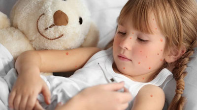 'Бангладешда қизамиқдан 100 га яқин бола вафот этди'ning rasmi