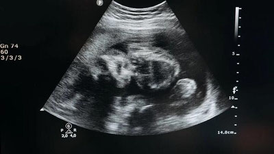 Изрображение 'Врачи в США научились лечить тяжелый дефект позвоночника еще у неродившихся детей'